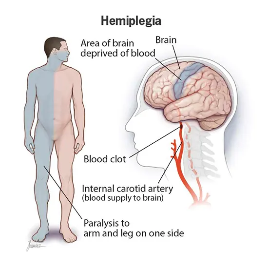 Fighting Back Against Neurology : Related Weakness and Paralysis